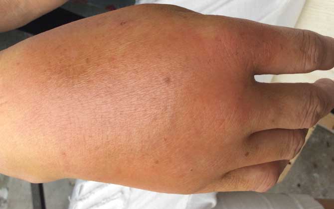 被虎頭蜂蟄了的人會怎樣?看圖片都疼,珍愛生命,遠離虎頭蜂! 被虎頭蜂蟄