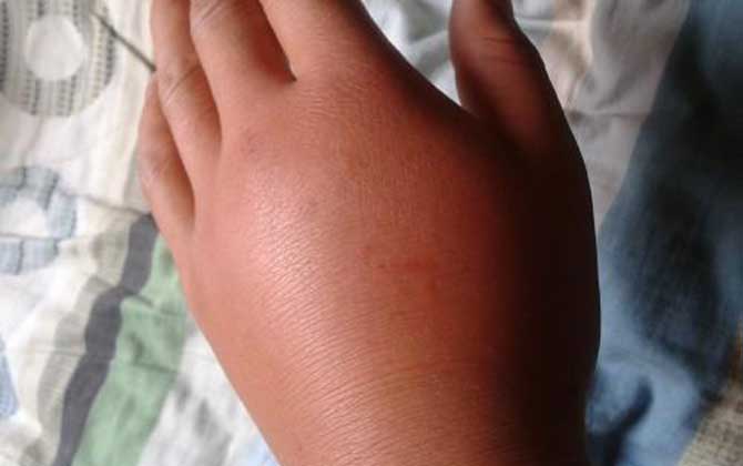 被虎頭蜂蟄了的人會怎樣?看圖片都疼,珍愛生命,遠離虎頭蜂! 被虎頭蜂蟄